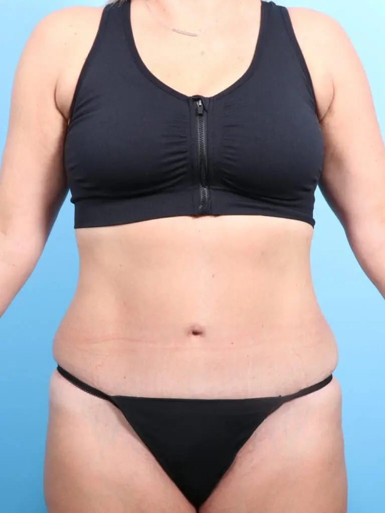 Tummy Tuck - Case 17115 - After