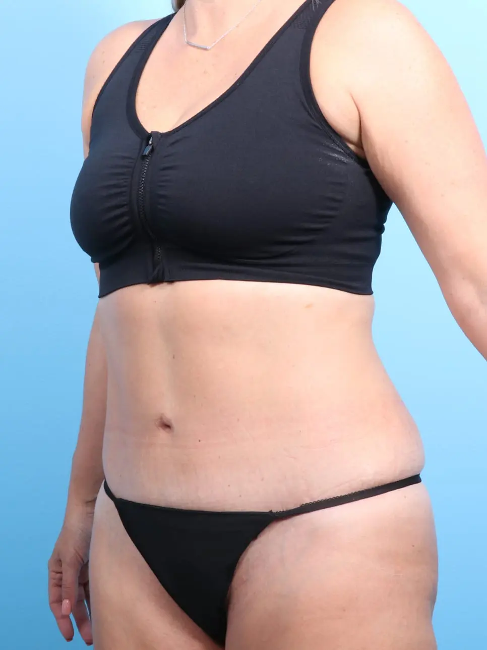 Tummy Tuck Patient Photo - Case 17115 - after view-1