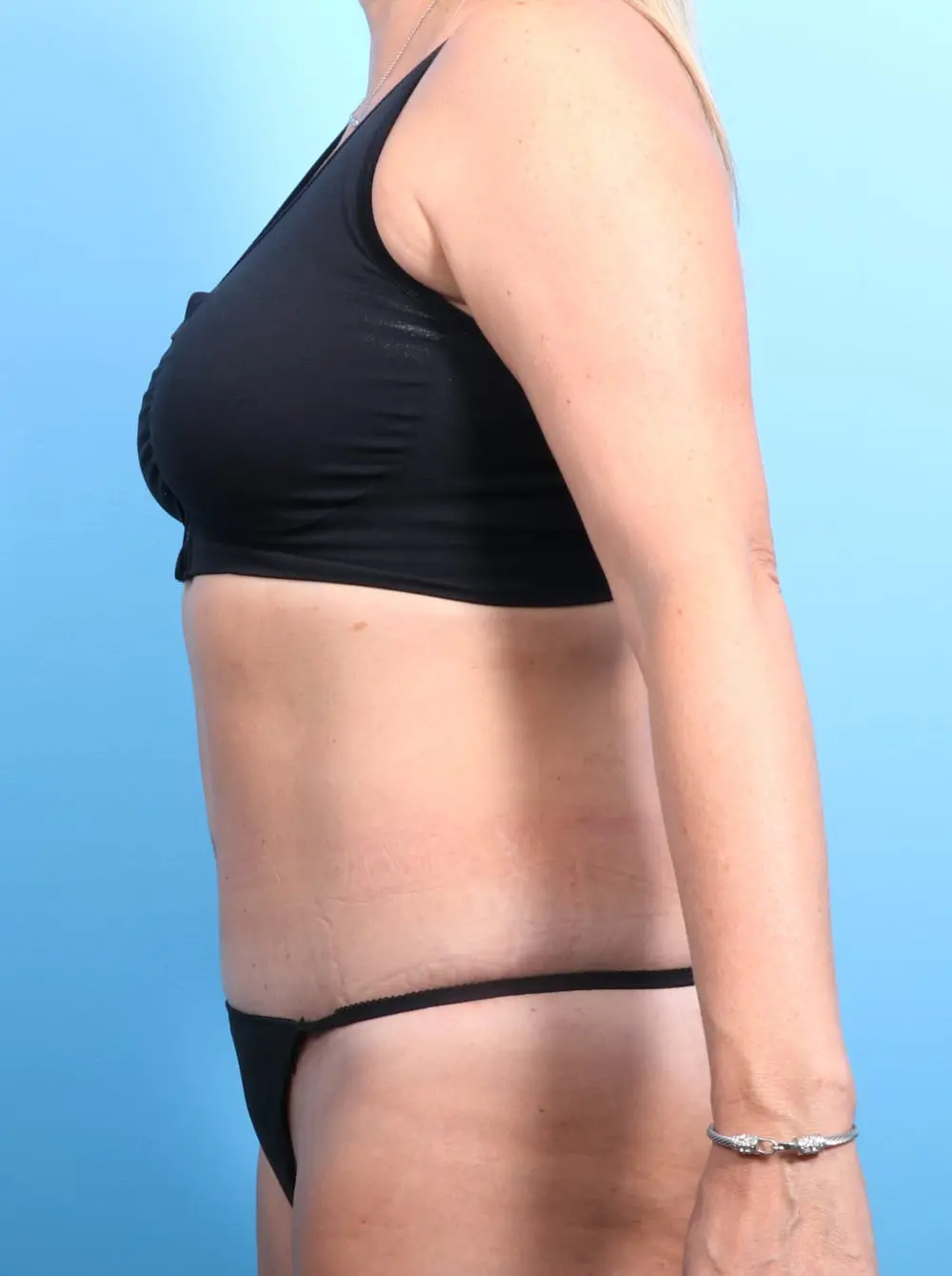 Tummy Tuck Patient Photo - Case 17115 - after view-2