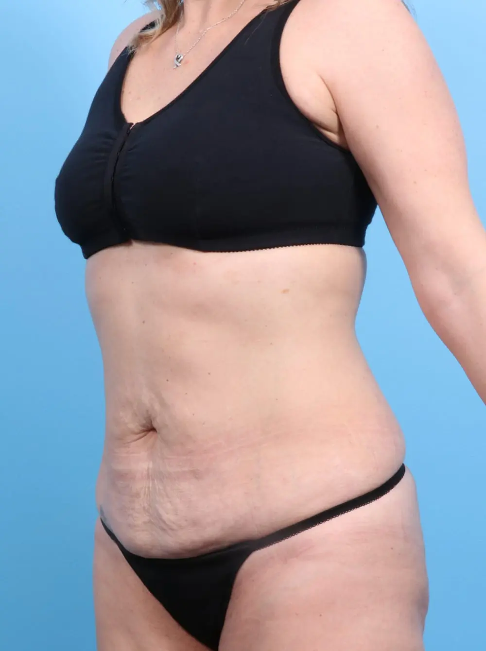 Tummy Tuck Patient Photo - Case 17115 - before view-1