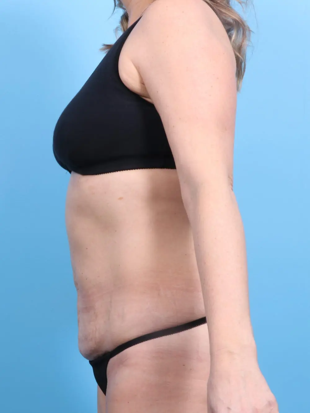 Tummy Tuck Patient Photo - Case 17115 - before view-2