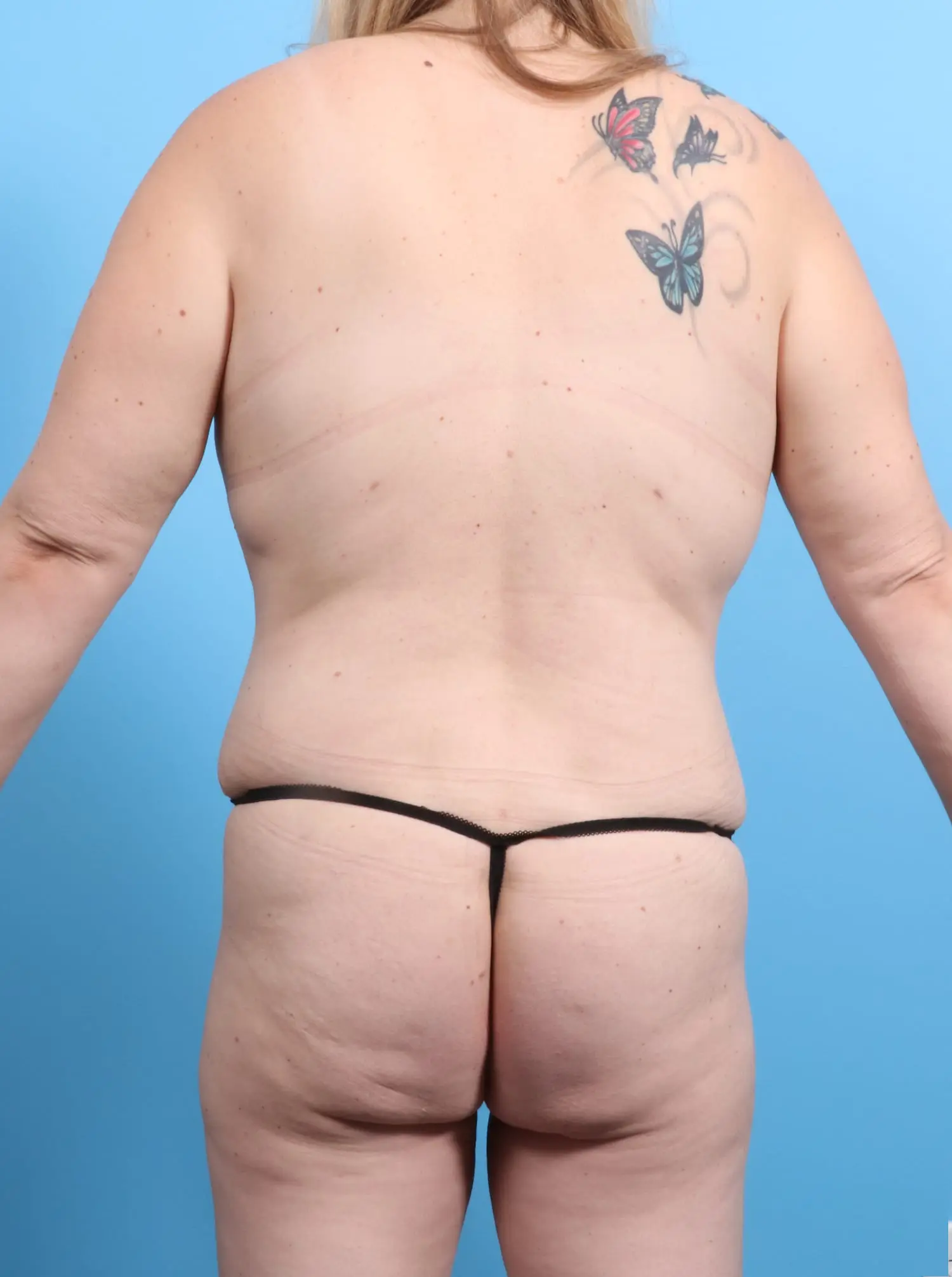 Mommy Makeover Patient Photo - Case 17163 - after view-3