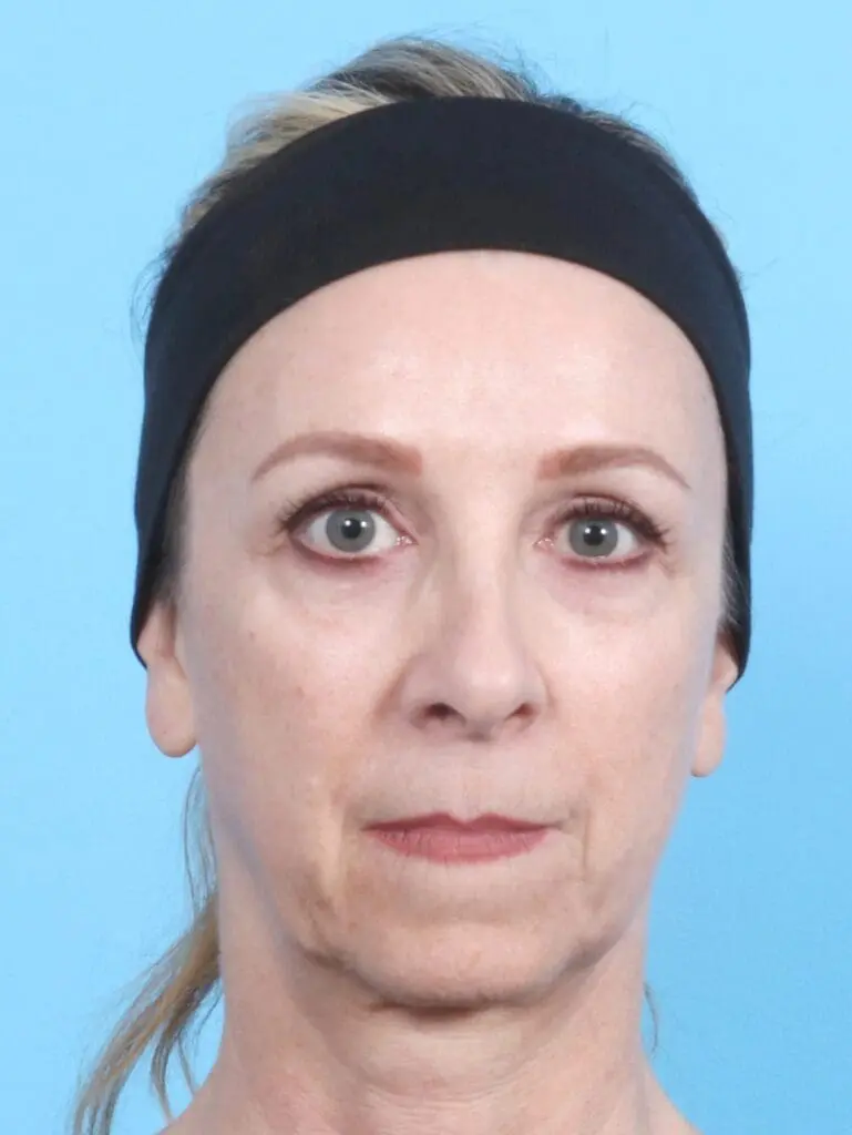 Brow Lift - Case 17179 - After