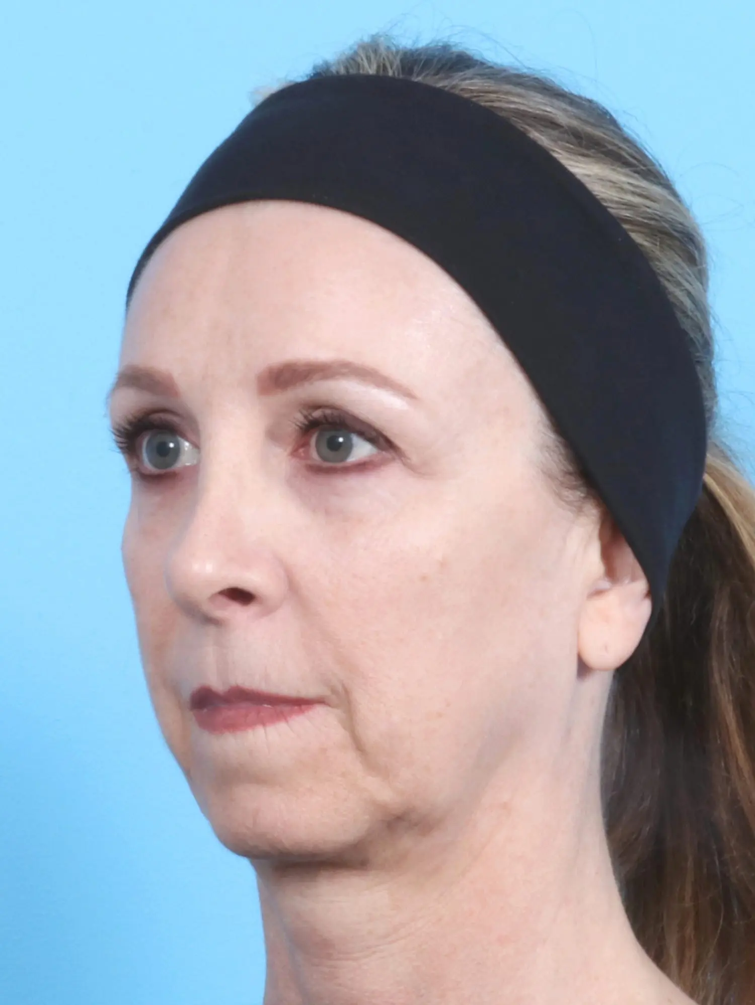 Brow Lift Patient Photo - Case 17179 - after view-1