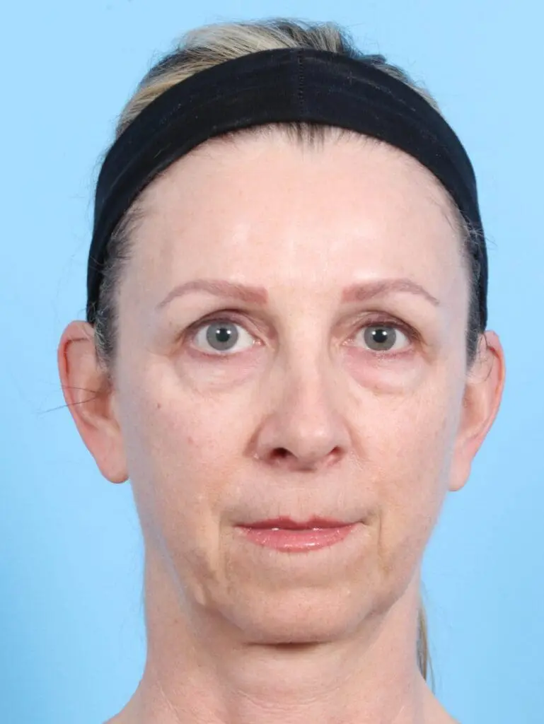 Brow Lift - Case 17179 - Before