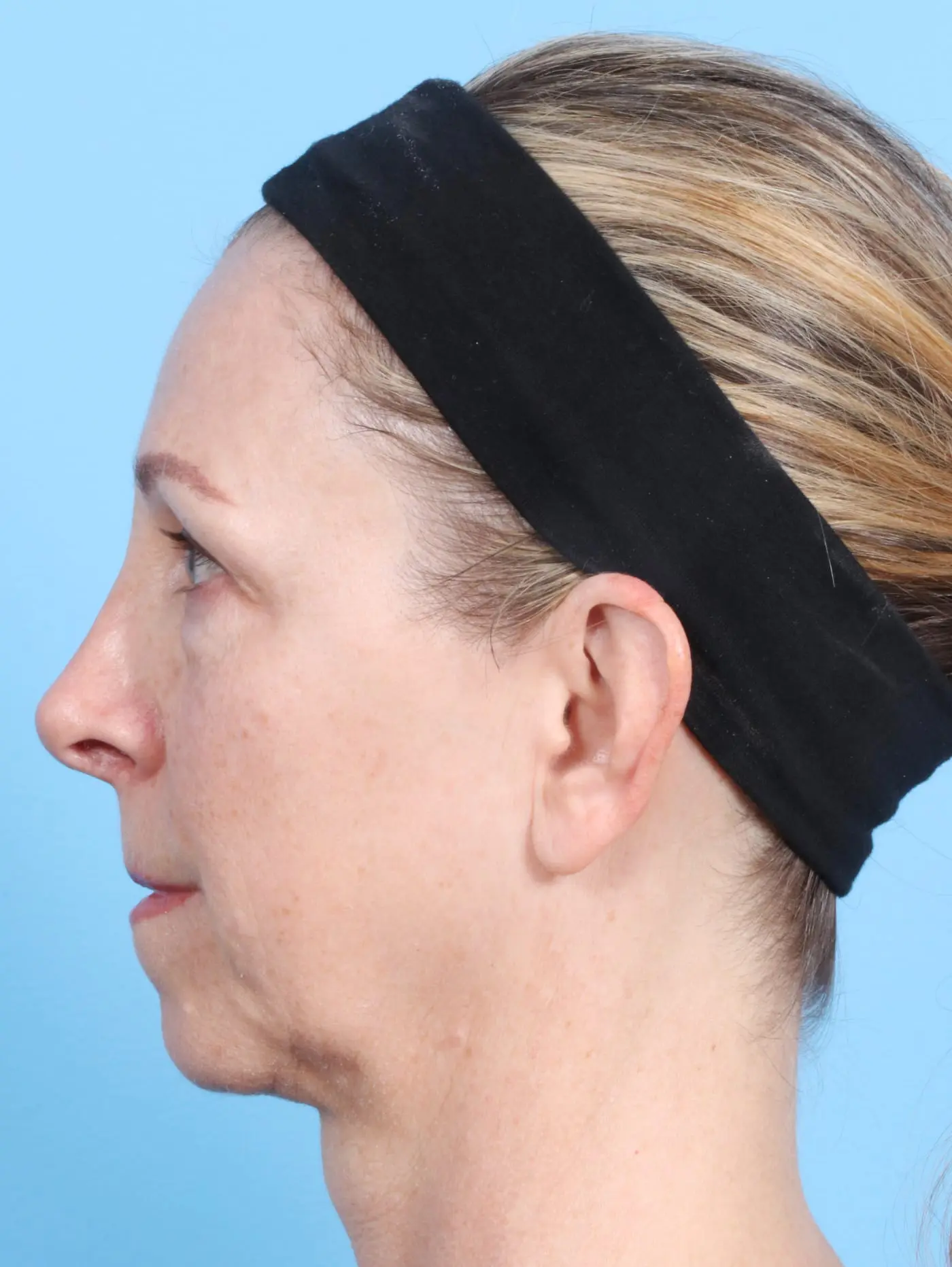 Brow Lift Patient Photo - Case 17179 - before view-2