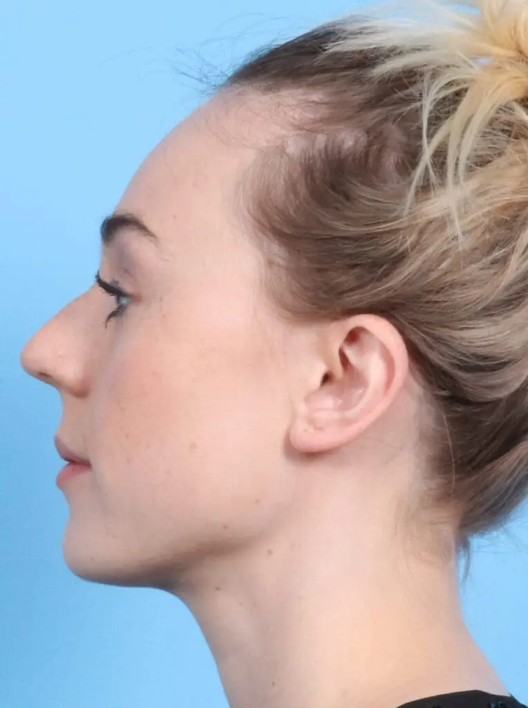 Rhinoplasty - Case 17200 - Before