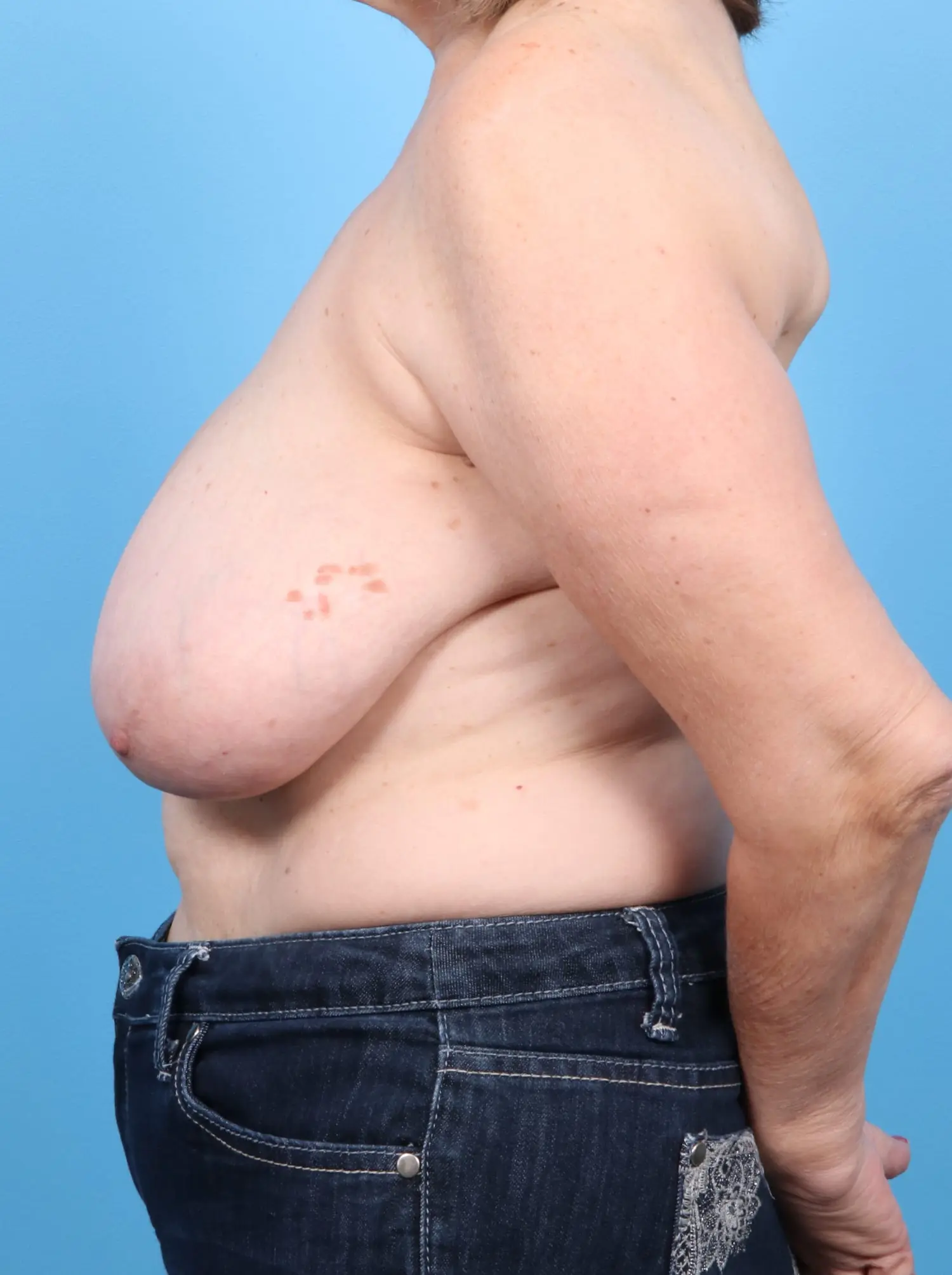 Breast Lift/Reduction w/o Implants Patient Photo - Case 17207 - before view-2