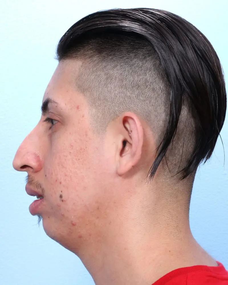 Chin Implant - Case 17366 - Before