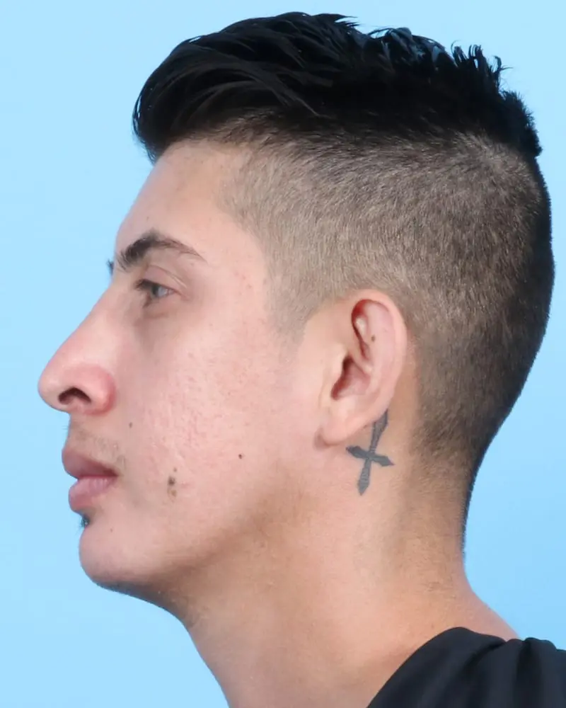 Chin Implant - Case 17366 - After