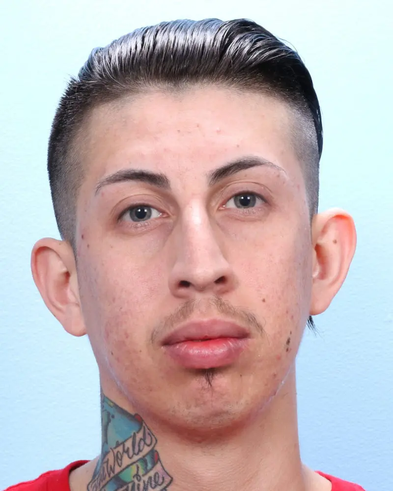 Chin Implant Patient Photo - Case 17366 - before view-1