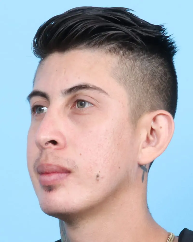 Chin Implant Patient Photo - Case 17366 - after view-2