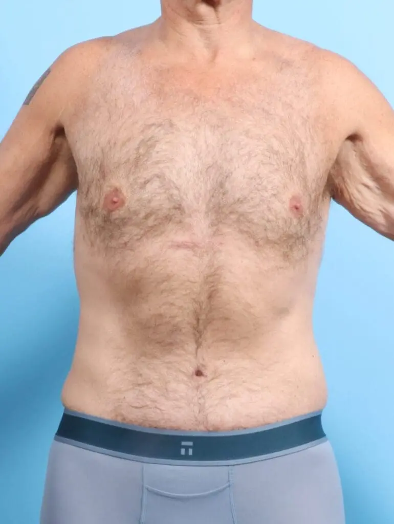 Male Body Lift - Case 17400 - After