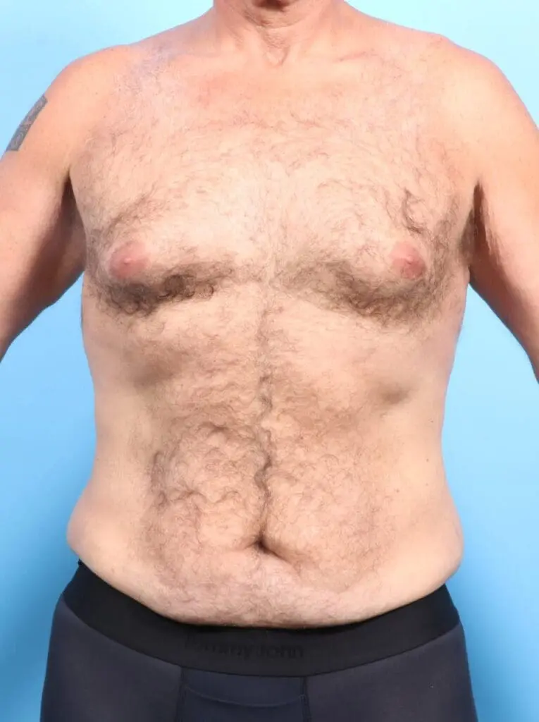 Male Body Lift - Case 17400 - Before