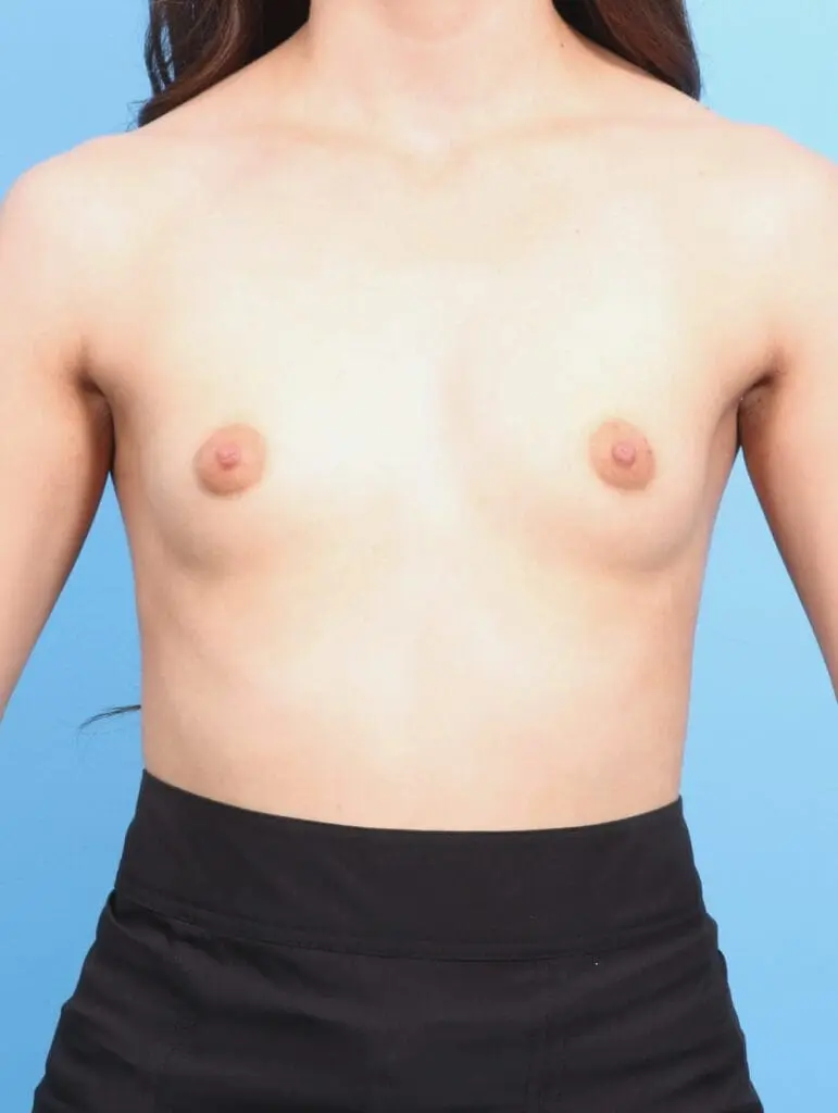 Breast Augmentation - Case 17409 - Before