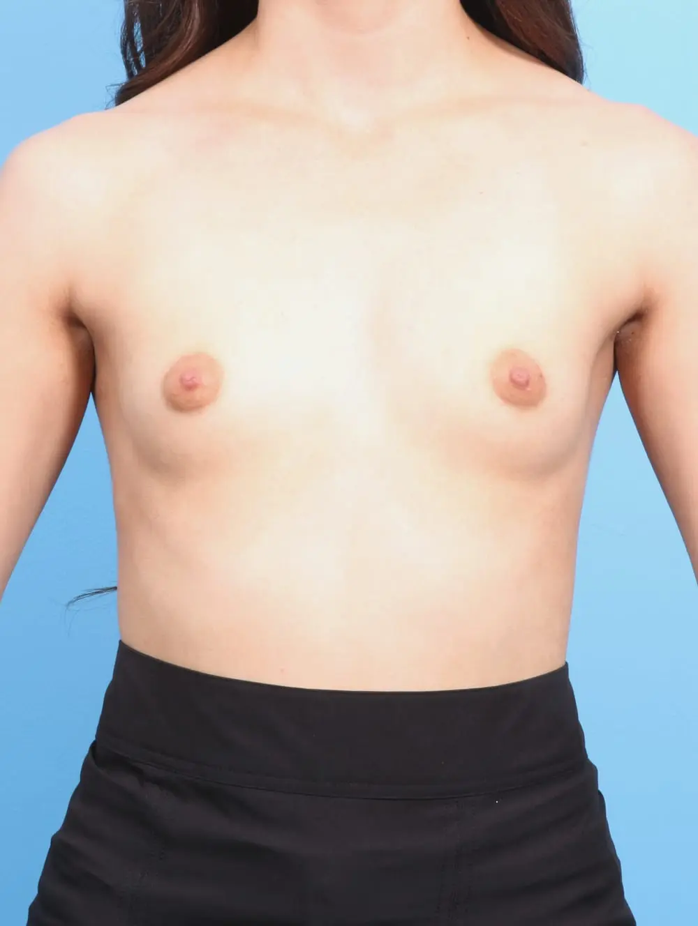 Breast Augmentation Patient Photo - Case 17409 - before view-
