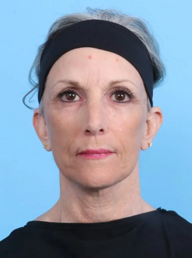 Facelift / Neck Lift - Case 17444 - After
