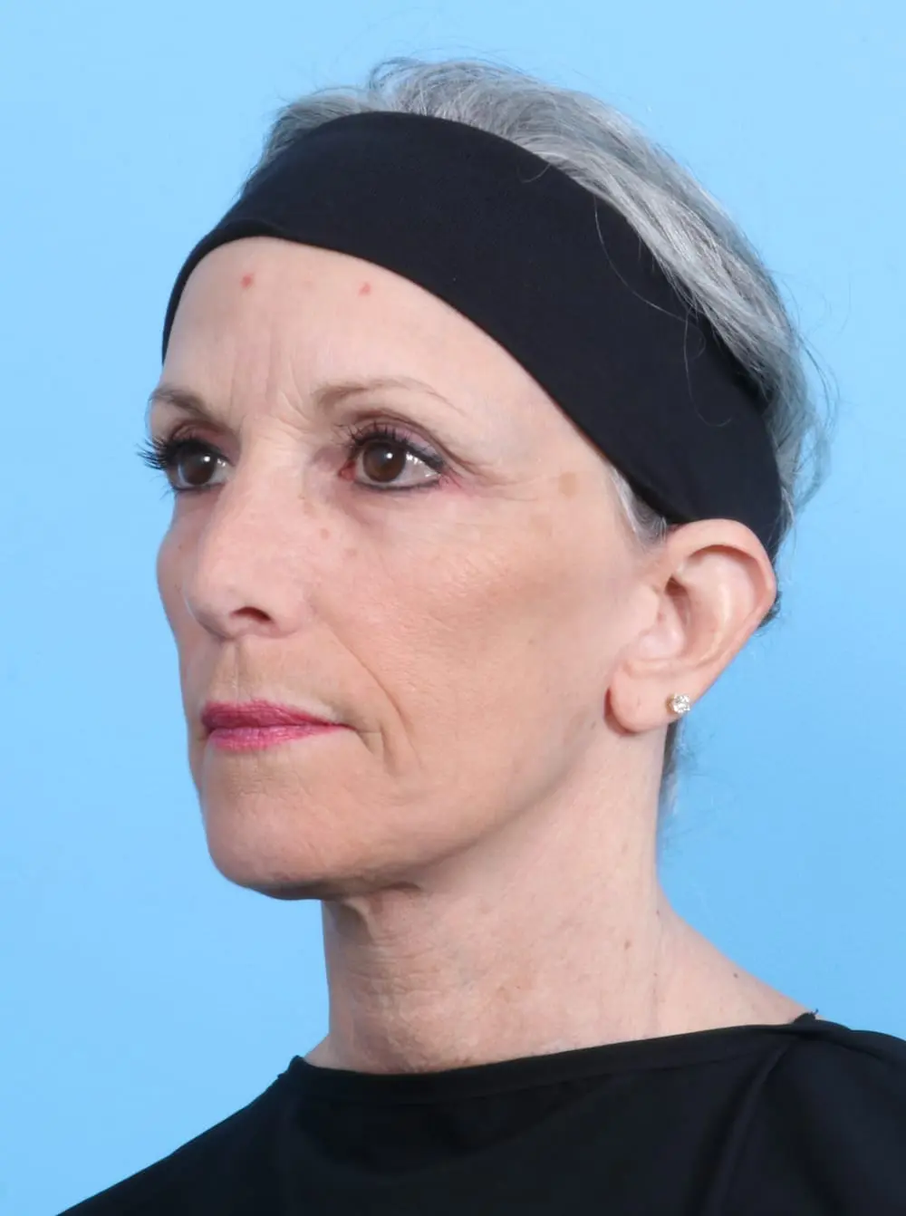 Facelift / Neck Lift Patient Photo - Case 17444 - after view-1