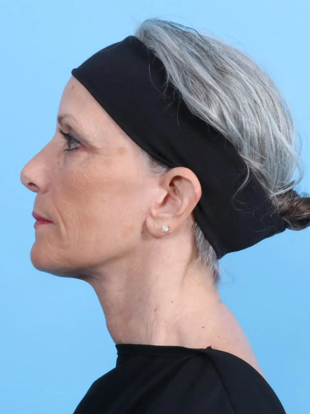 Facelift / Neck Lift Patient Photo - Case 17444 - after view-2
