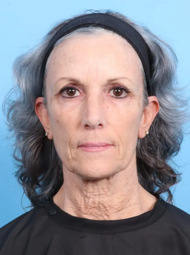 Facelift / Neck Lift - Case 17444 - Before