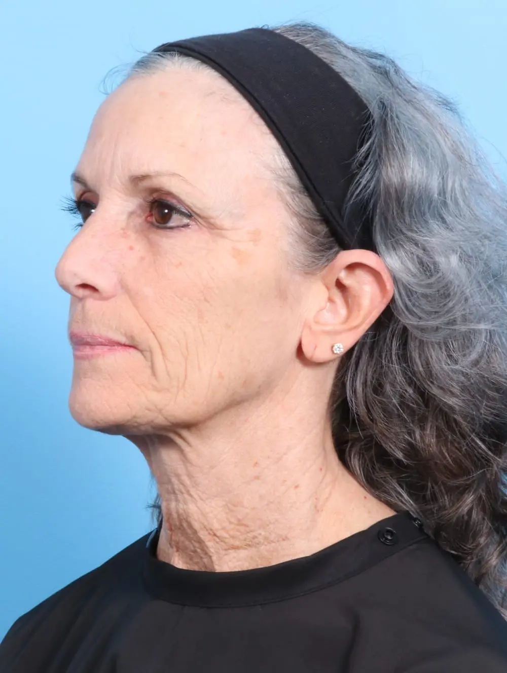 Facelift / Neck Lift Patient Photo - Case 17444 - before view-1