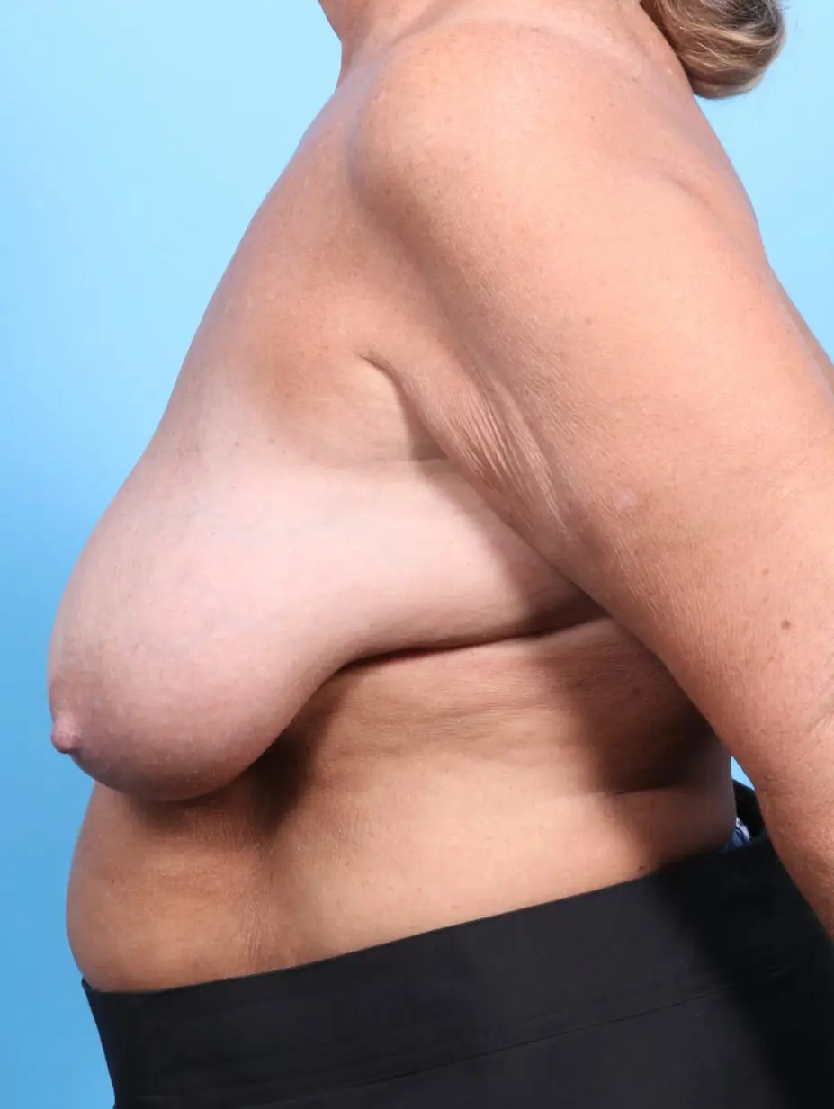 Breast Lift/Reduction w/o Implants Patient Photo - Case 17451 - before view-2