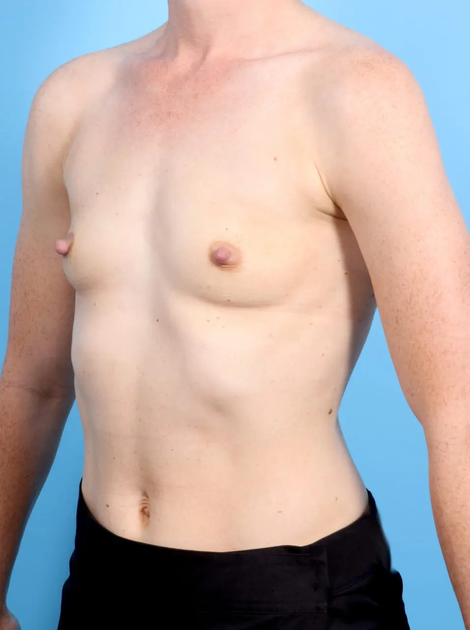 Breast Augmentation Patient Photo - Case 17458 - before view-1