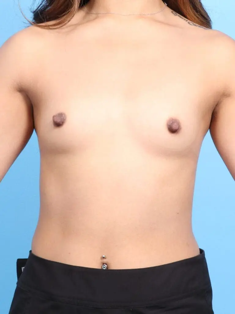 Breast Augmentation - Case 17575 - Before