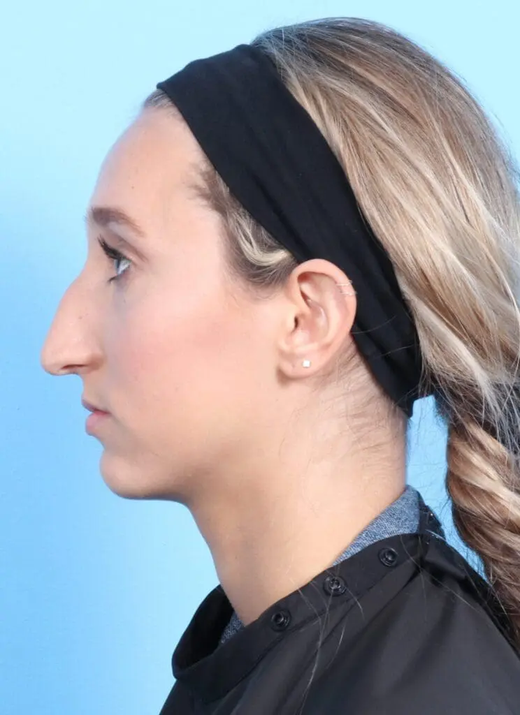 Rhinoplasty - Case 17625 - Before
