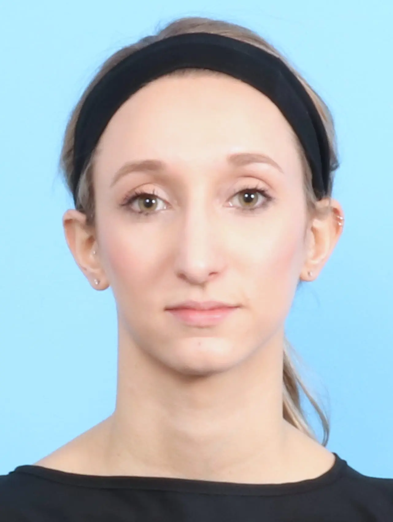 Rhinoplasty Patient Photo - Case 17625 - after view-1