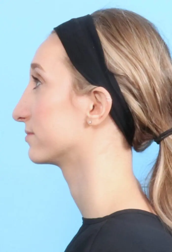 Rhinoplasty - Case 17625 - After