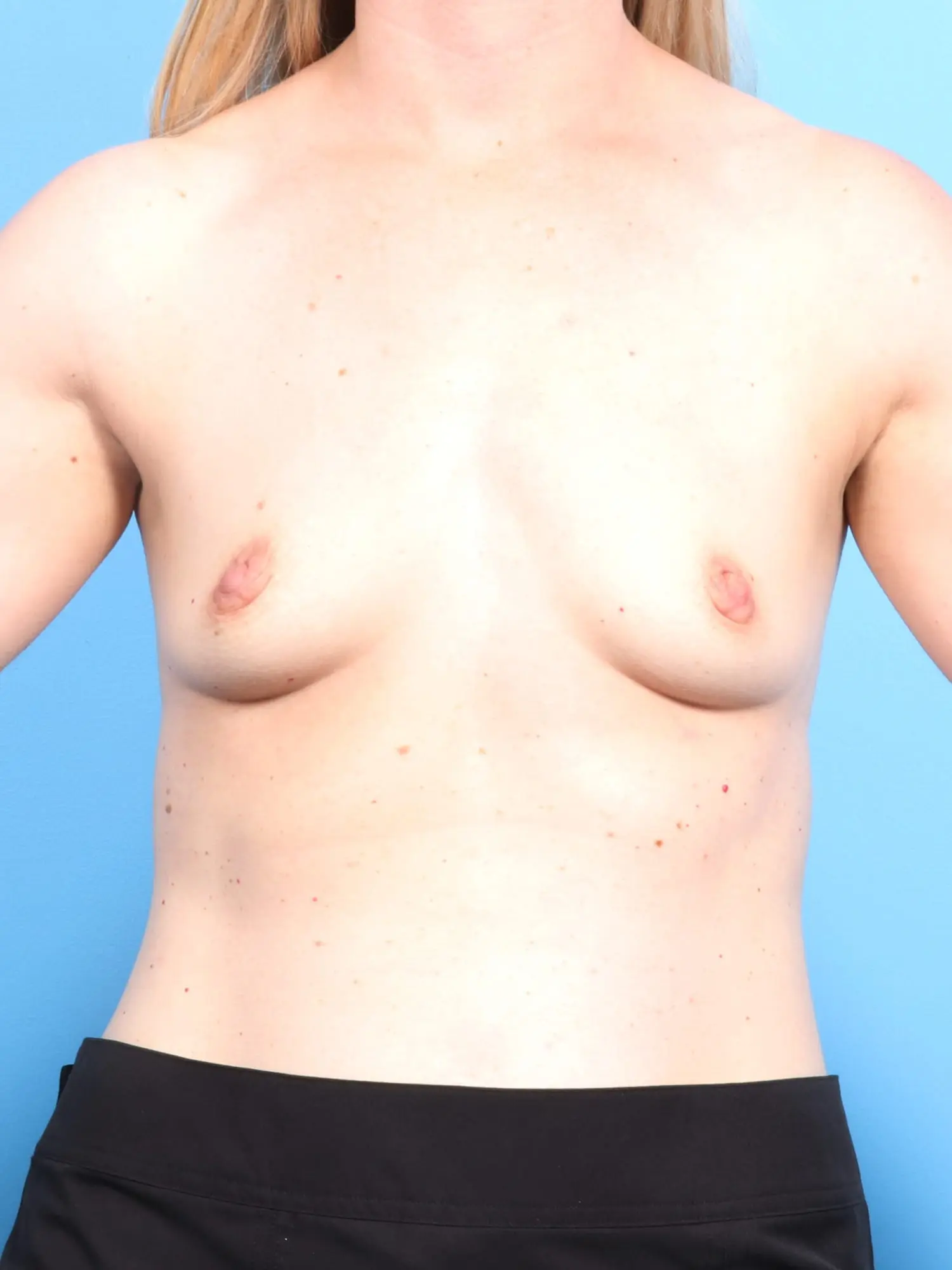 Breast Augmentation Patient Photo - Case 18060 - before view-