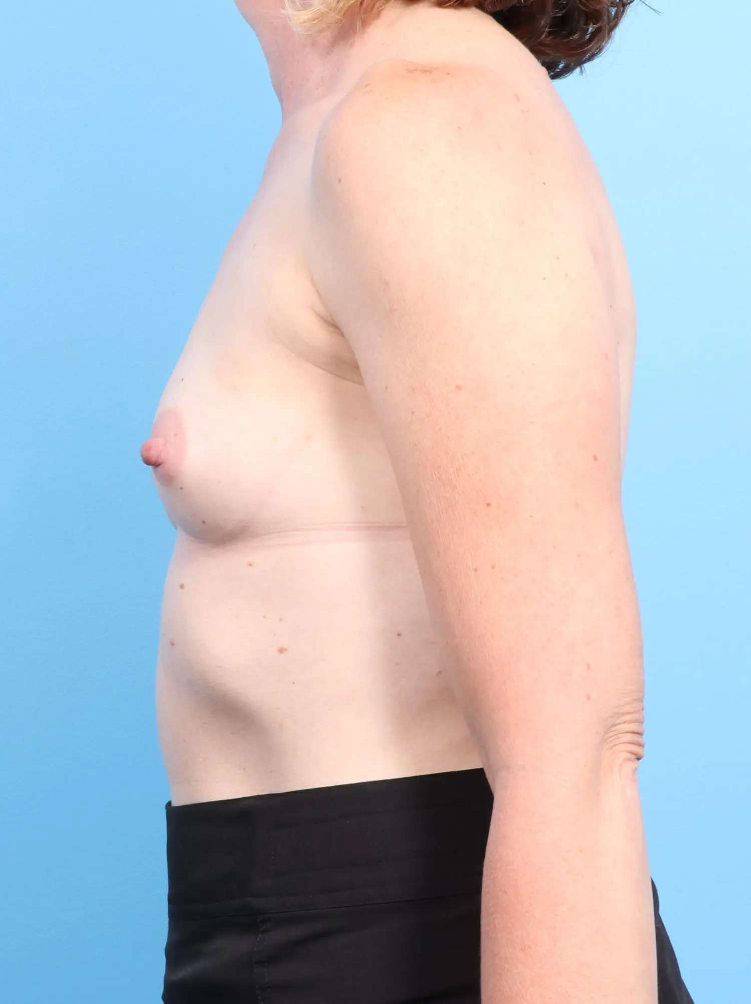 Breast Augmentation Patient Photo - Case 18076 - before view-2