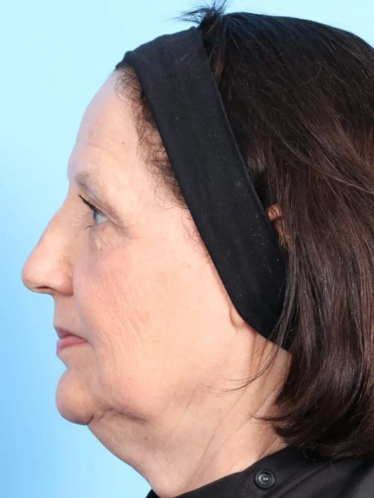 Rhinoplasty - Case 18084 - Before