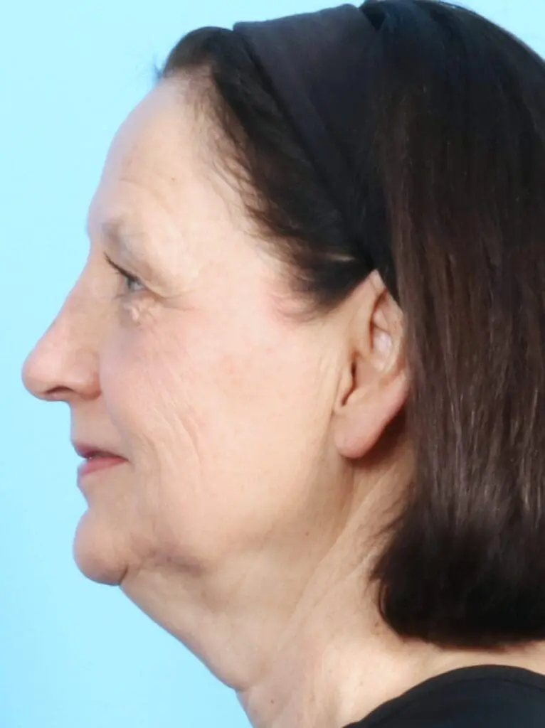 Rhinoplasty - Case 18084 - After