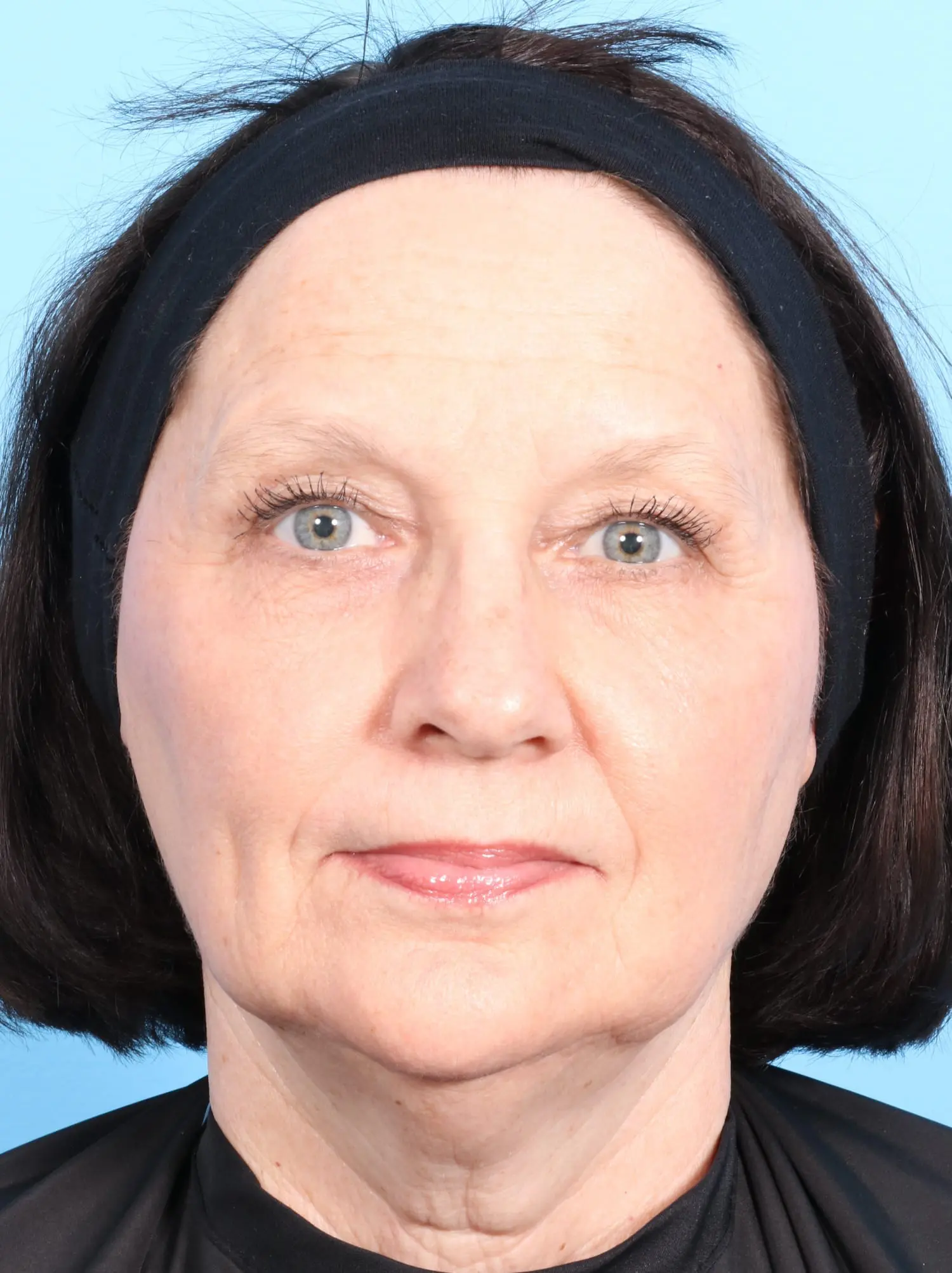 Rhinoplasty Patient Photo - Case 18084 - before view-1