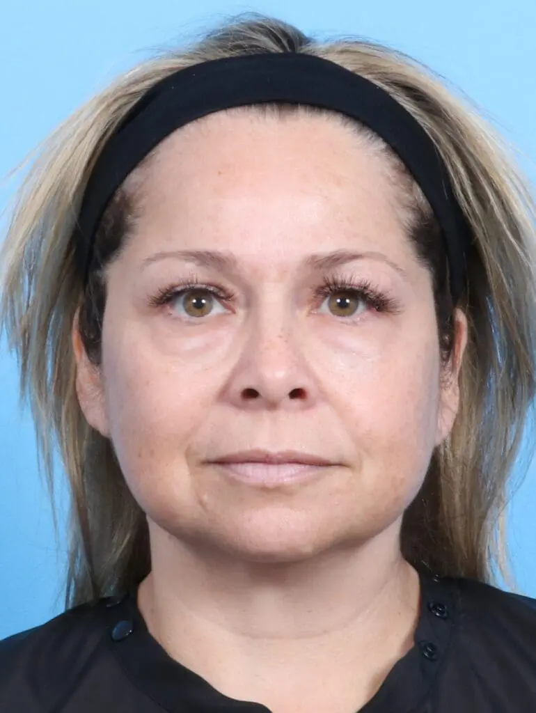 Eyelid Surgery - Case 18092 - Before