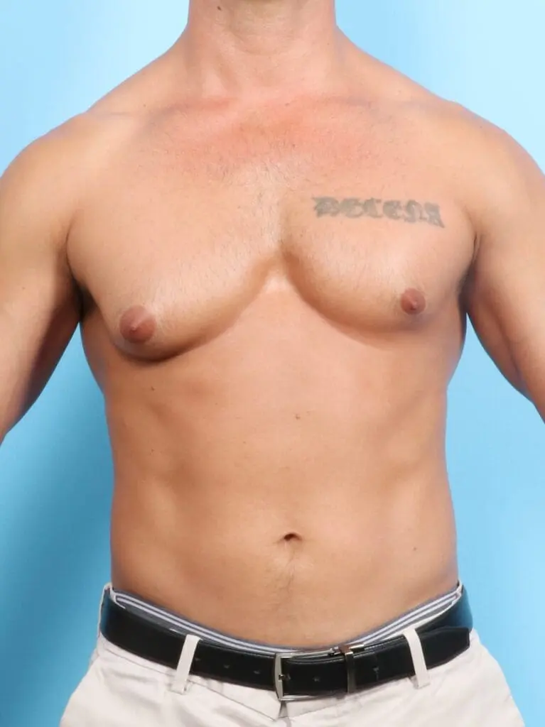 Gynecomastia - Case 18120 - Before