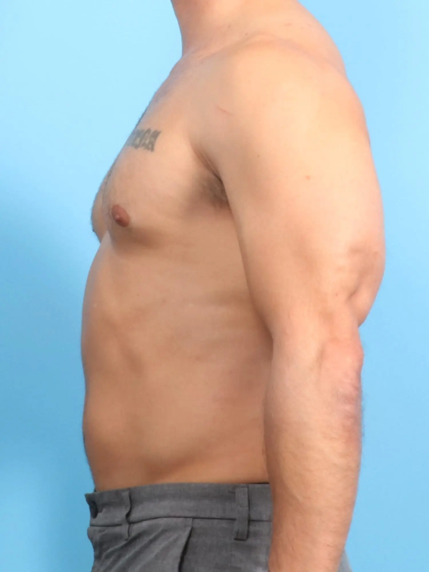 Gynecomastia Patient Photo - Case 18120 - after view-2