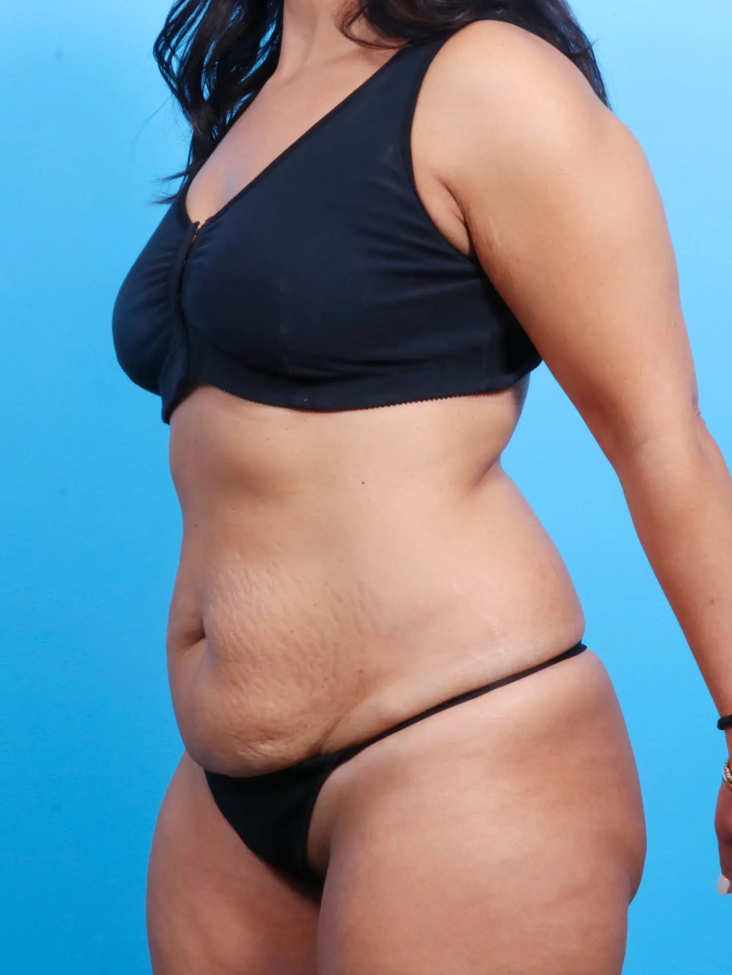 Tummy Tuck Patient Photo - Case 18128 - before view-1