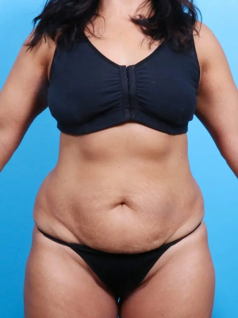 Tummy Tuck - Case 18128 - Before