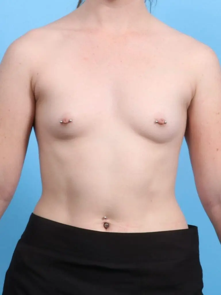 Breast Augmentation - Case 18797 - Before