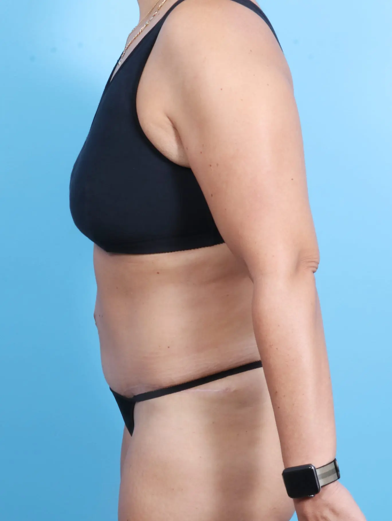 Tummy Tuck Patient Photo - Case 18805 - after view-2