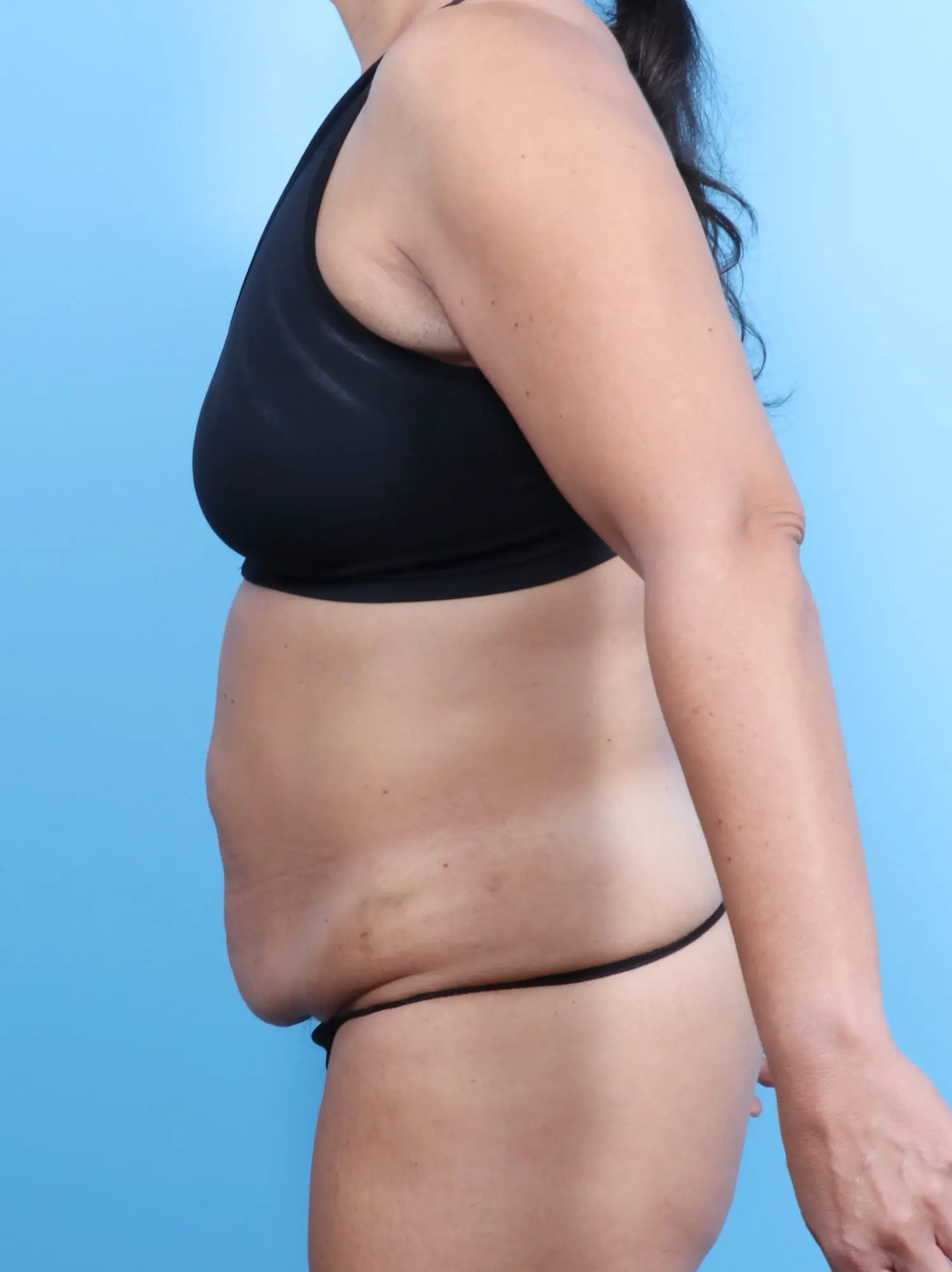 Tummy Tuck Patient Photo - Case 18805 - before view-2