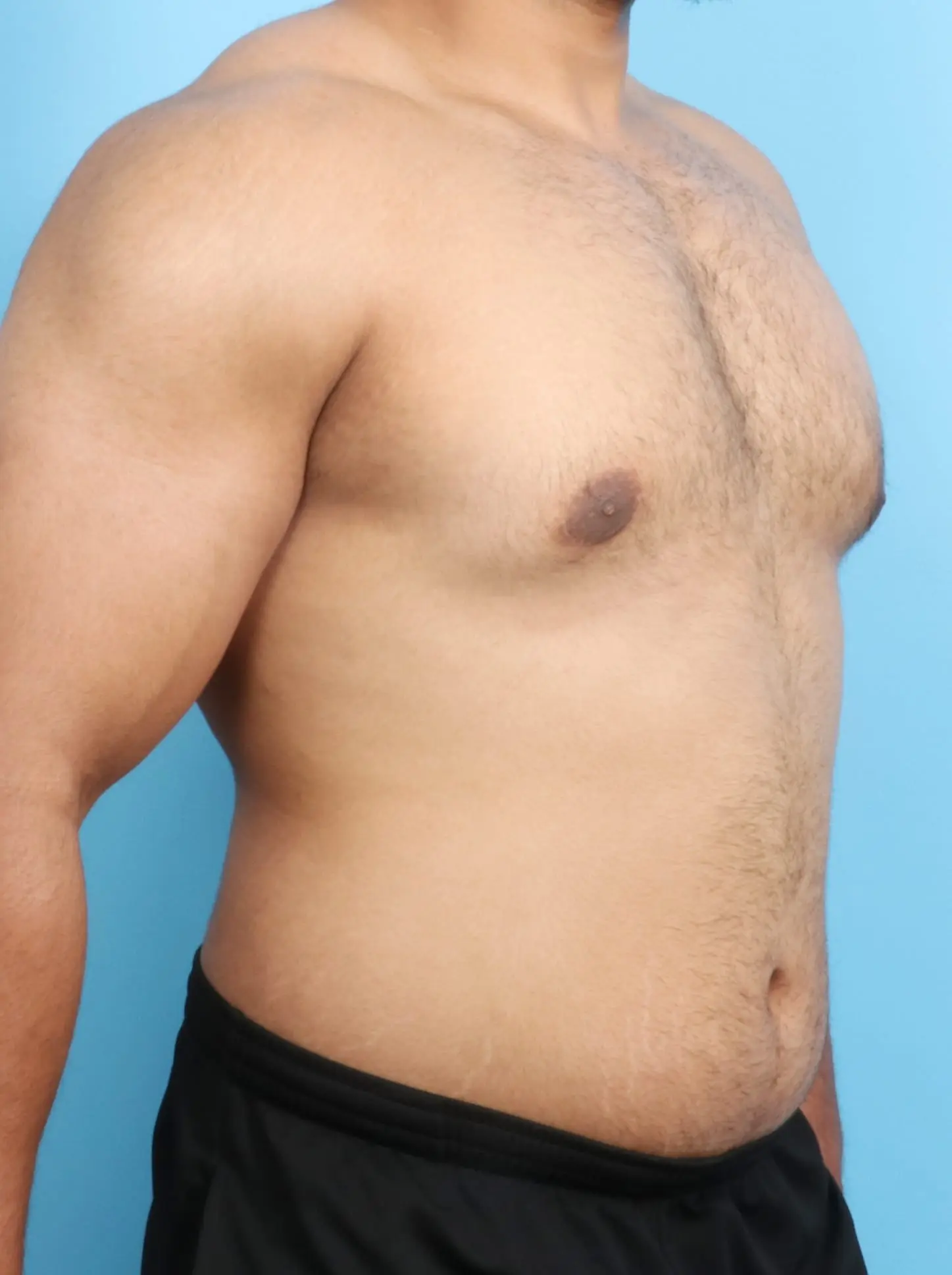 Gynecomastia Patient Photo - Case 18814 - after view-1