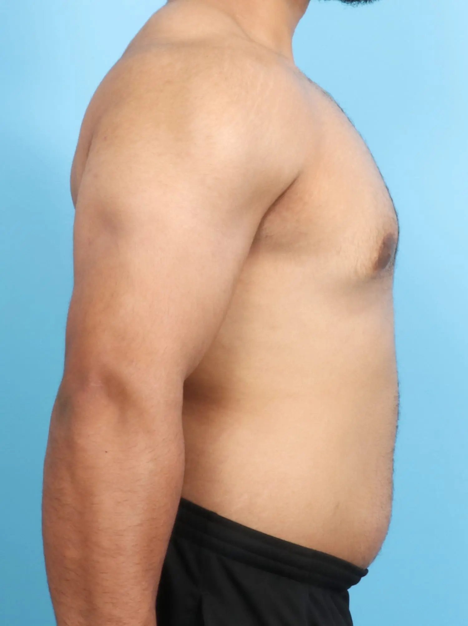 Gynecomastia Patient Photo - Case 18814 - after view-2
