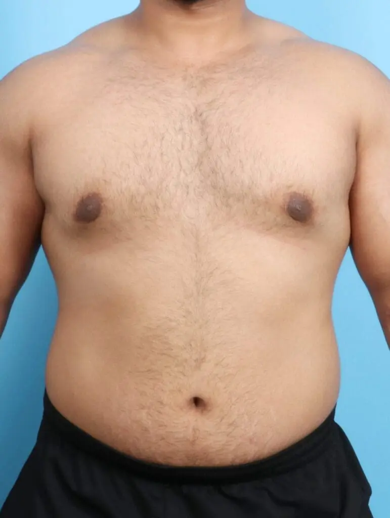 Gynecomastia - Case 18814 - After