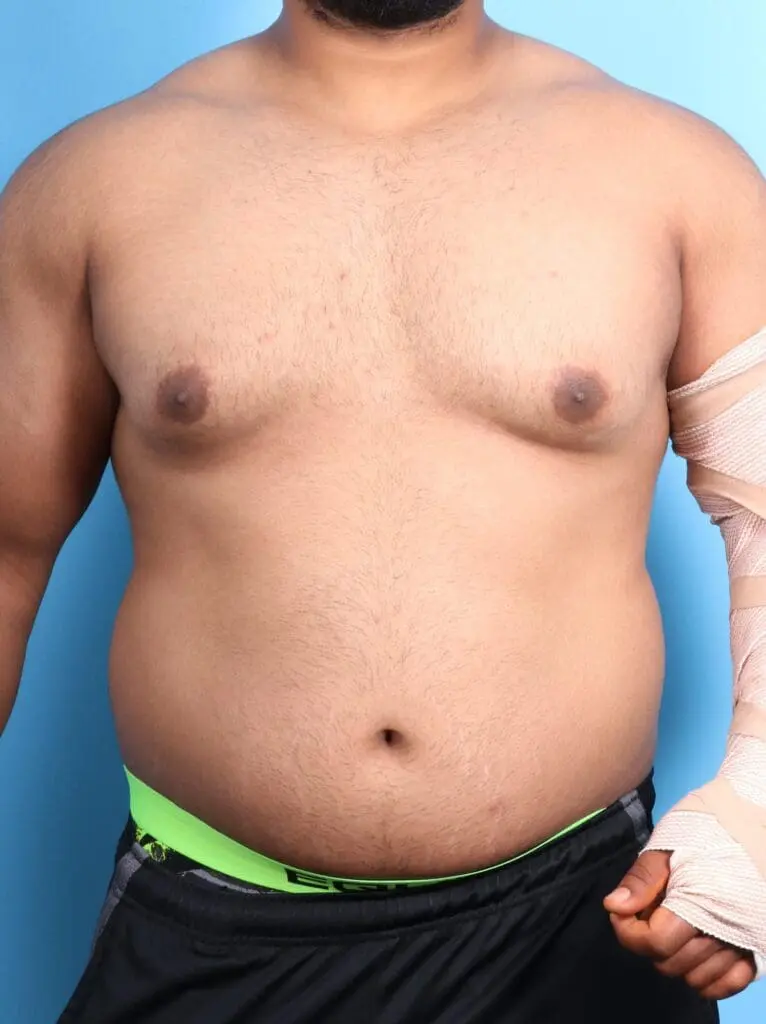 Gynecomastia - Case 18814 - Before