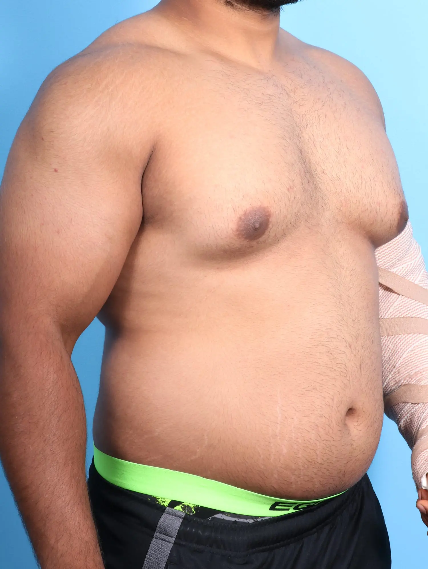 Gynecomastia Patient Photo - Case 18814 - before view-1