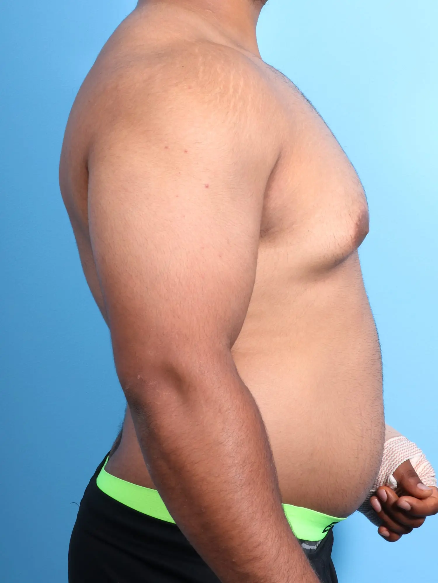 Gynecomastia Patient Photo - Case 18814 - before view-2